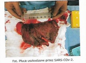 Płuca uszkodzone przez SARS-COv-2